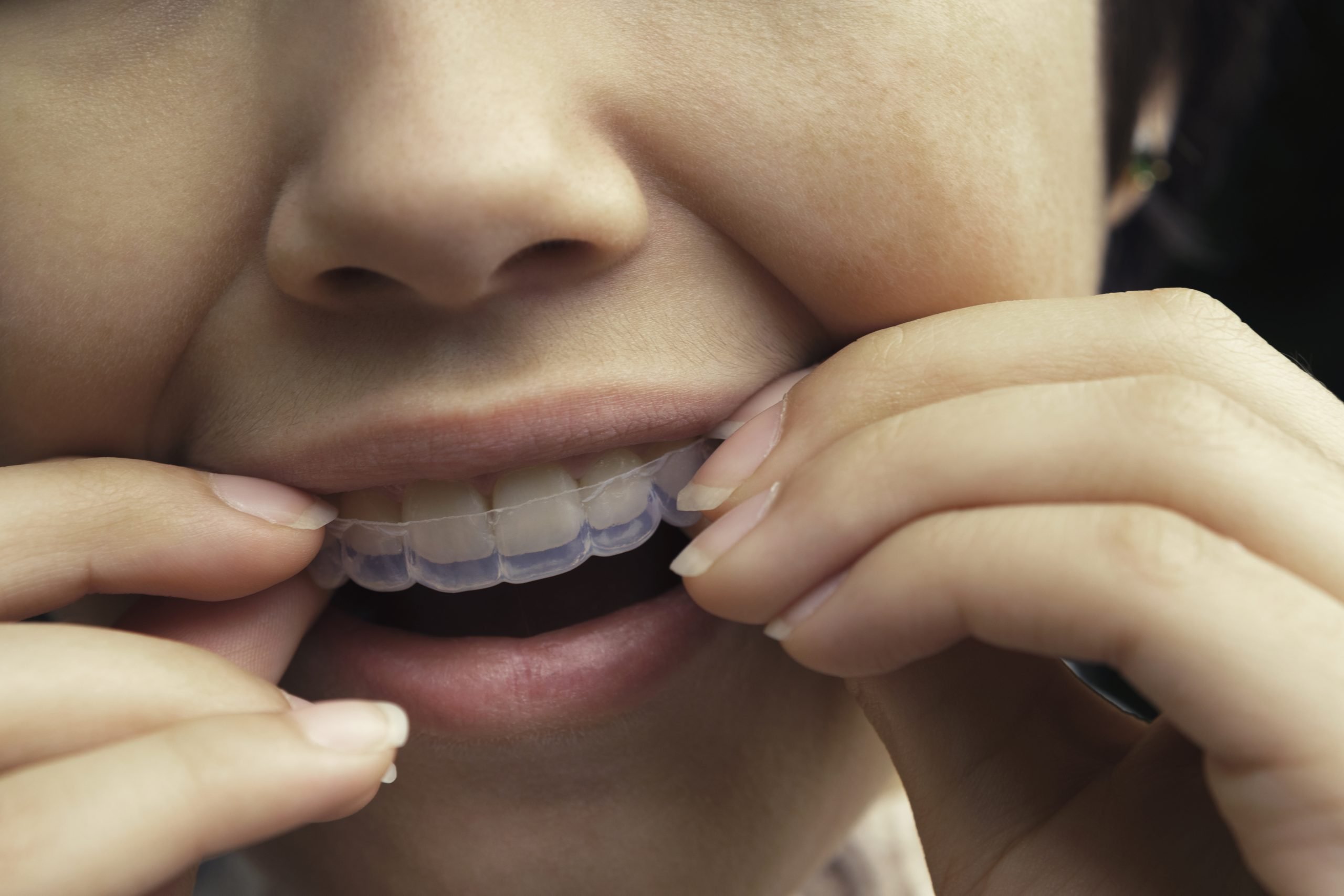 Clear Aligners right for you?